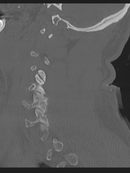 Cavernoma of cervical cord (Radiopaedia 50838-56346 Sagittal bone window 60).png