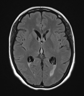 File:Cavernoma with bleed - midbrain (Radiopaedia 54546-60774 Axial FLAIR 16).png