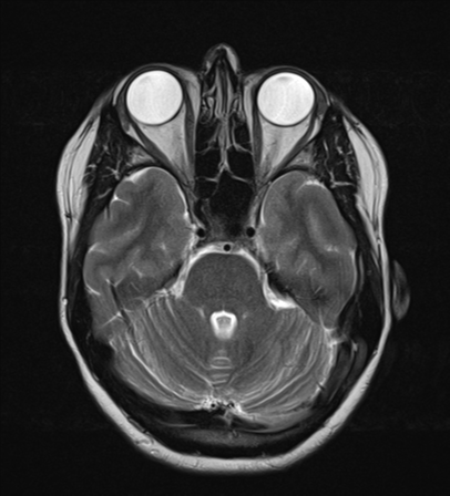 File:Cavernoma with bleed - midbrain (Radiopaedia 54546-60774 Axial T2 8).png