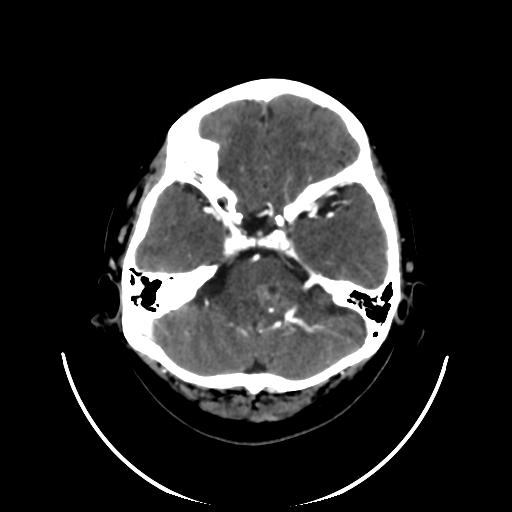 File:Cavernoma with developmental venous anomaly (Radiopaedia 22470-22506 C+ arterial phase 9).jpg