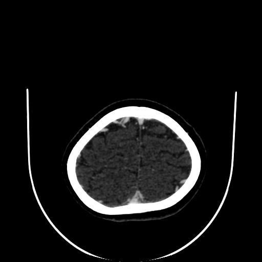 Cavernoma with developmental venous anomaly (Radiopaedia 22470-22506 C 175).jpg