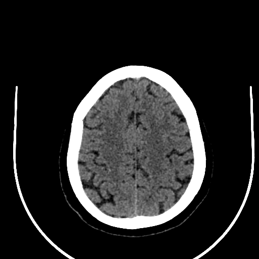 Cavernous hemangioma of the cerebellar falx (Radiopaedia 73025-83723 Axial non-contrast 105).jpg