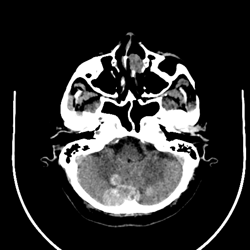Cavernous hemangioma of the cerebellar falx (Radiopaedia 73025-83723 Axial non-contrast 26).jpg
