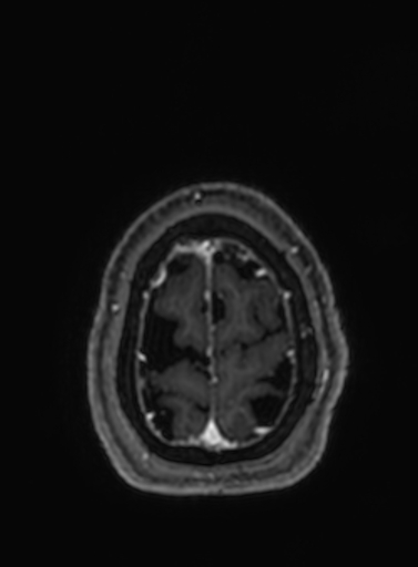 Cavernous hemangioma of the cerebellar falx (Radiopaedia 73025-83724 Axial T1 C+ 38).jpg