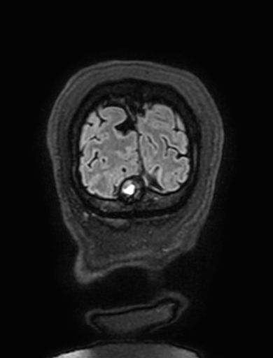 Cavernous hemangioma of the cerebellar falx (Radiopaedia 73025-83724 Coronal FLAIR 335).jpg