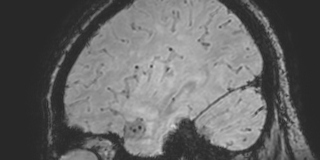 File:Cavernous hemangioma of the cerebellar falx (Radiopaedia 73025-83724 Sagittal BOLD 157).jpg