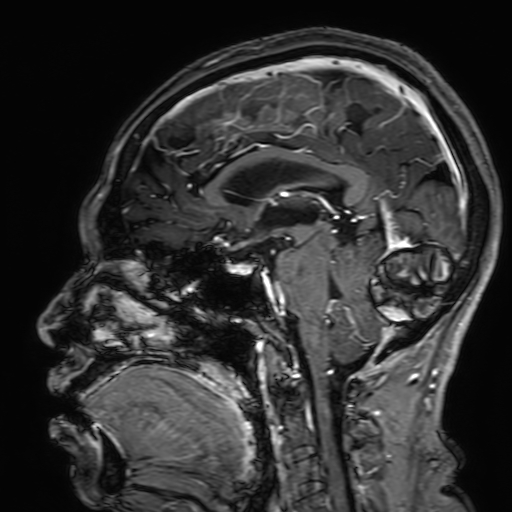 Cavernous hemangioma of the cerebellar falx (Radiopaedia 73025-83724 Sagittal T1 C+ 110).jpg