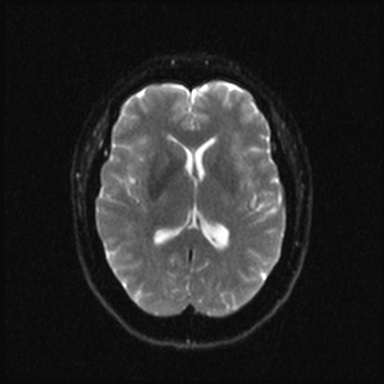 Cavernous sinus meningioma (Radiopaedia 63682-72367 DWI 13).jpg