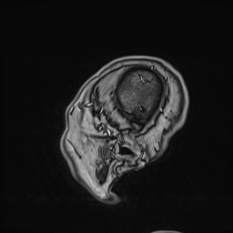 Cavernous sinus meningioma (Radiopaedia 63682-72367 Sagittal T1 C+ 157).jpg