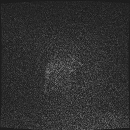 Cavernous sinus meningioma (Radiopaedia 63682-72367 Sagittal T1 C+ 6).jpg