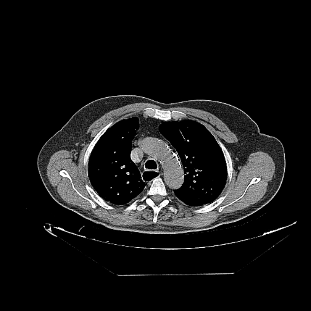 Cavitating bronchogenic carcinoma (Radiopaedia 44489-48162 Axial non-contrast 21).jpg