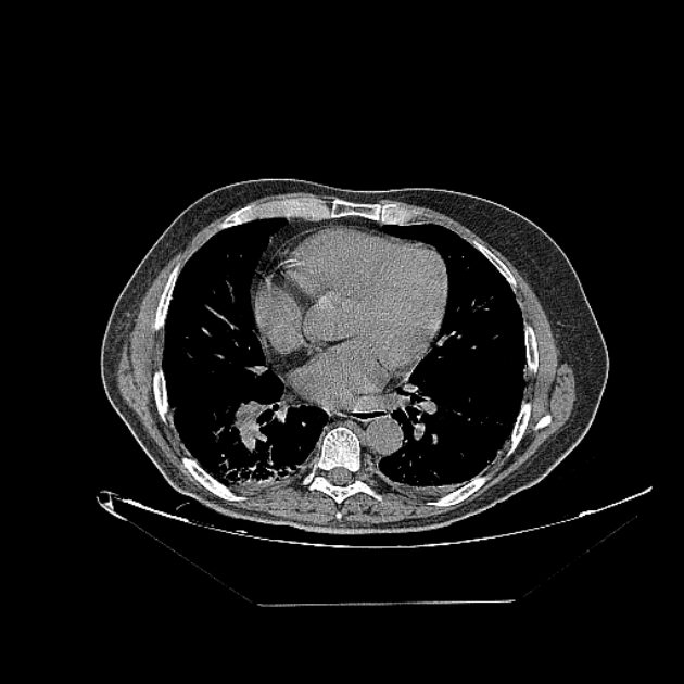 Cavitating bronchogenic carcinoma (Radiopaedia 44489-48162 Axial non-contrast 53).jpg