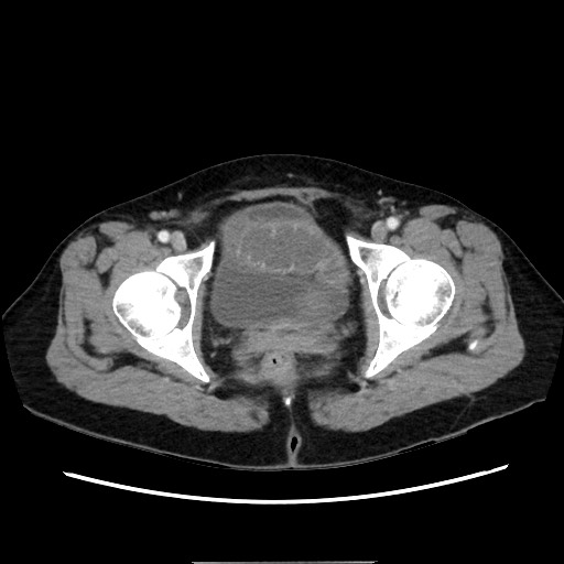 Cecal adenocarcinoma (Radiopaedia 75909-87331 A 83).jpg