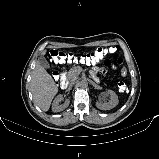 Cecal adenocarcinoma (Radiopaedia 85324-100916 Axial non-contrast 31).jpg