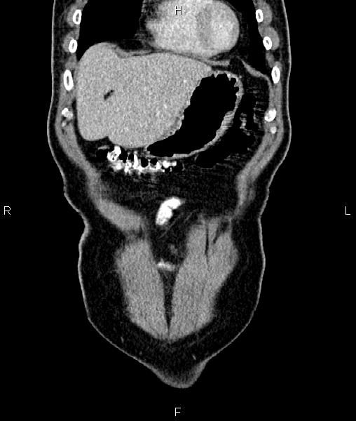 Cecal cancer with appendiceal mucocele (Radiopaedia 91080-108651 D 11).jpg