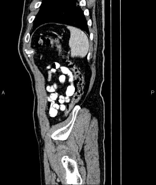 File:Cecal cancer with appendiceal mucocele (Radiopaedia 91080-108651 E 85).jpg