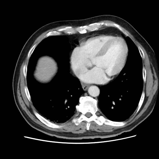 Cecal mass causing appendicitis (Radiopaedia 59207-66531 A 8).jpg