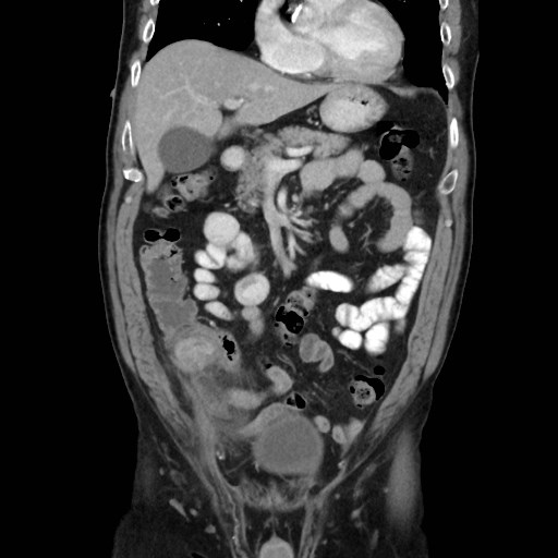 Cecal mass causing appendicitis (Radiopaedia 59207-66531 B 19).jpg