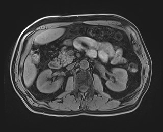 Cecal mass causing appendicitis (Radiopaedia 59207-66532 Axial T1 57).jpg