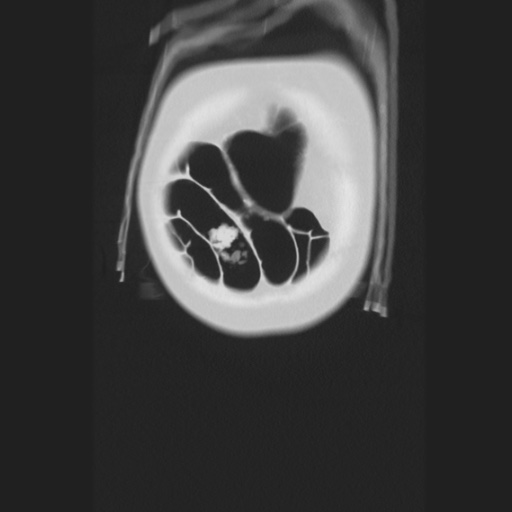 Cecal volvulus (Radiopaedia 75378-86620 Coronal lung window 18).jpg