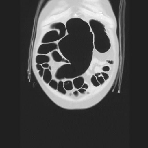 Cecal volvulus (Radiopaedia 75378-86620 Coronal lung window 29).jpg