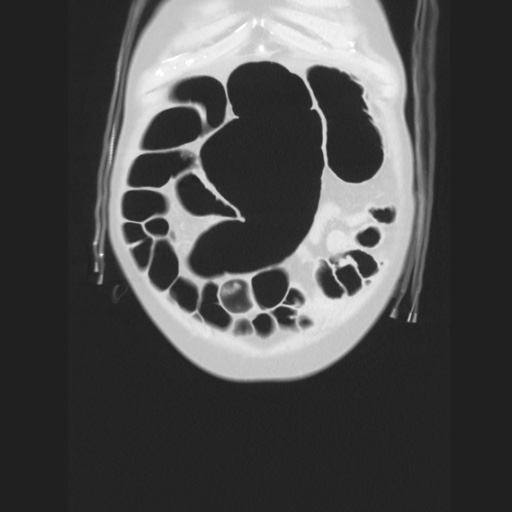 Cecal volvulus (Radiopaedia 75378-86620 Coronal lung window 30).jpg