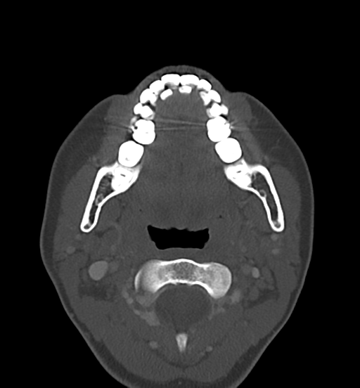 Cemento-ossifying fibroma (Radiopaedia 46243-50643 Axial bone window 39).png