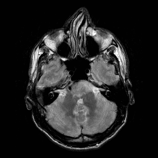 File:Central-variant posterior reversible encephalopathy syndrome (PRES) (Radiopaedia 43880-47358 Axial T2 5).jpg