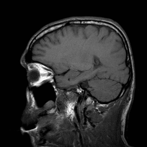 File:Central-variant posterior reversible encephalopathy syndrome (PRES) (Radiopaedia 43880-47359 Sagittal T1 7).jpg