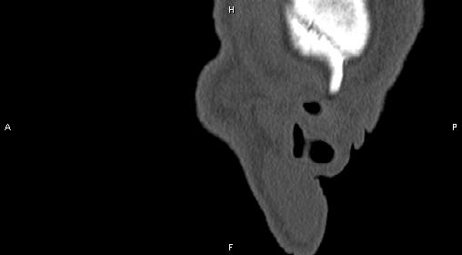 File:Central giant cell granuloma (Radiopaedia 83346-97761 Sagittal bone window 48).jpg