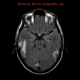 File:Central nervous system vasculitis (Radiopaedia 8410-9235 Axial FLAIR 9).jpg