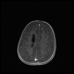 Central neurocytoma (Radiopaedia 30220-30842 Axial T1 C+ 119).jpg