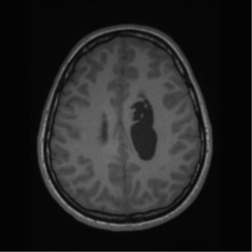 File:Central neurocytoma (Radiopaedia 37664-39557 Axial T1 52).png