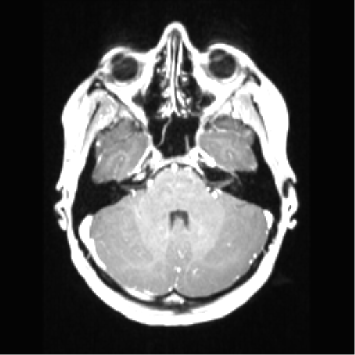 Central neurocytoma (Radiopaedia 37664-39557 Axial T1 C+ 23).png