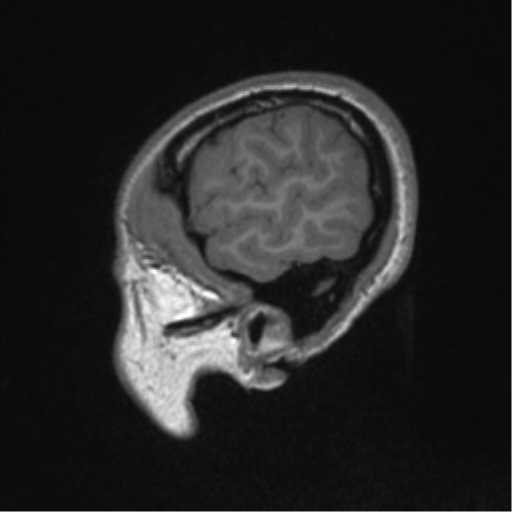 File:Central neurocytoma (Radiopaedia 37664-39557 Sagittal T1 14).png