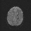 Central neurocytoma (Radiopaedia 56690-63469 Axial DWI 35).jpg
