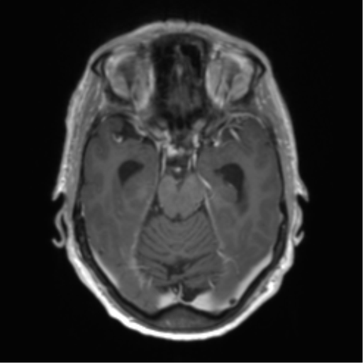 Central neurocytoma (Radiopaedia 65317-74345 Axial T1 C+ 17).png
