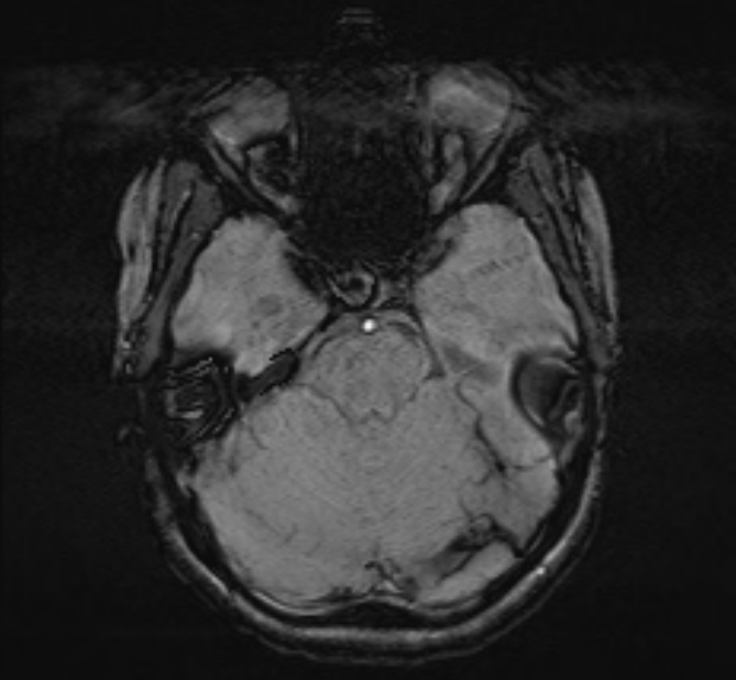 Central neurocytoma (Radiopaedia 70263-80336 Axial SWI 16).jpg
