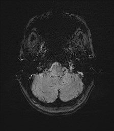 Central neurocytoma (Radiopaedia 84497-99872 Axial SWI 11).jpg