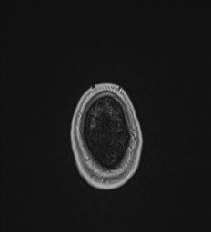 Central neurocytoma (Radiopaedia 84497-99872 Axial T1 C+ 147).jpg