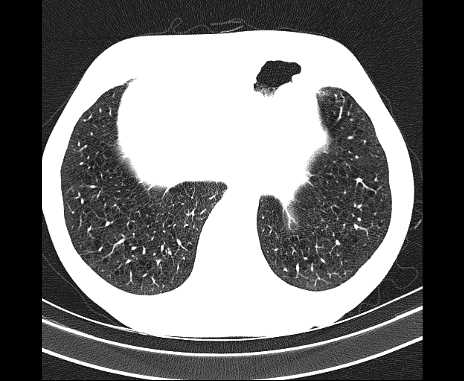 Centrilobular pulmonary emphysema (Radiopaedia 62468-70718 Axial lung window 66).jpg