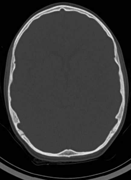 Cerebellar abscess (Radiopaedia 73727-84527 Axial bone window 35).jpg