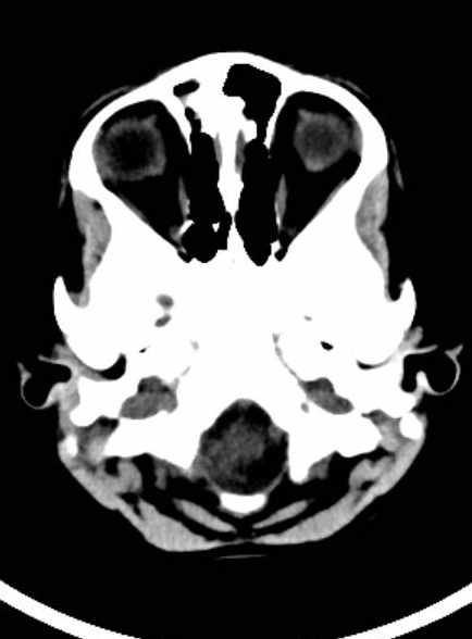 Cerebellar abscess (Radiopaedia 73727-84527 Axial non-contrast 22).jpg
