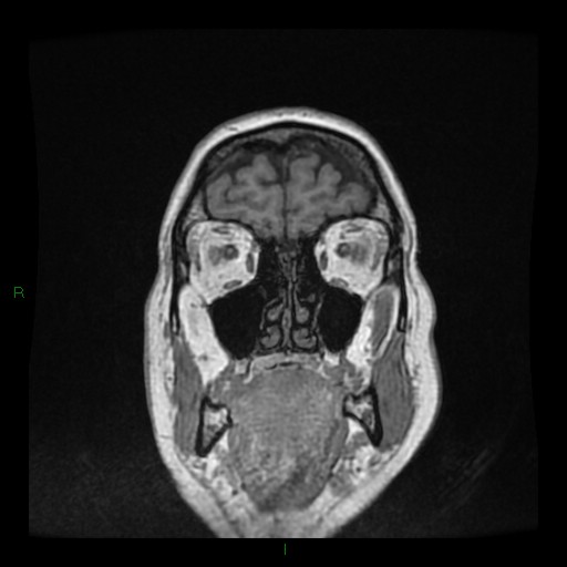 File:Cerebellar abscess (Radiopaedia 78135-90678 Coronal T1 C+ 23).jpg