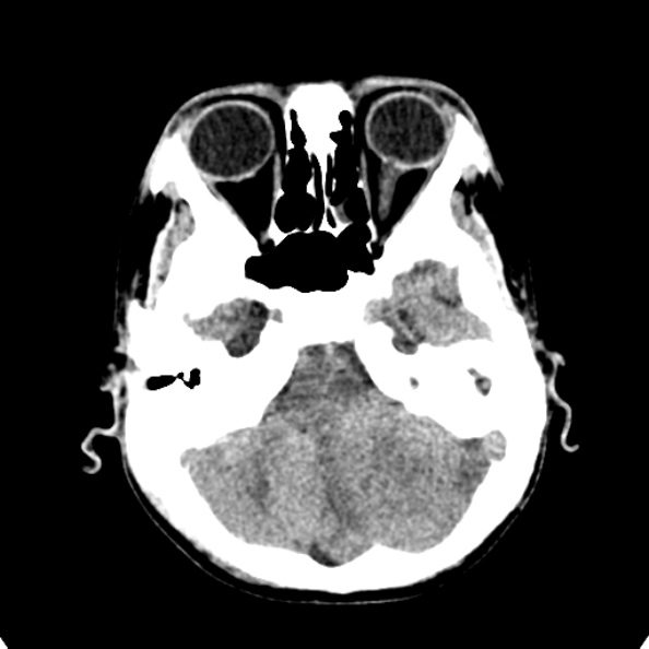 File:Cerebellar abscess secondary to mastoiditis (Radiopaedia 26284-26412 Axial non-contrast 33).jpg