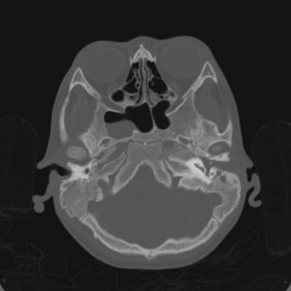 Cerebellar abscess secondary to mastoiditis (Radiopaedia 26284-26413 Axial bone window 42).jpg