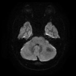 Cerebellar hemangioblastoma (Radiopaedia 29570-30077 Axial DWI 8).jpg