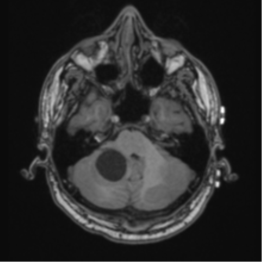 File:Cerebellar hemangioblastomas and pituitary adenoma (Radiopaedia 85490-101176 Axial T1 18).png