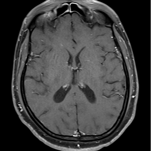 File:Cerebellar hemangioblastomas and pituitary adenoma (Radiopaedia 85490-101176 Axial T1 C+ fat sat 24).png