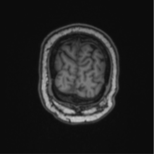 Cerebellar hemangioblastomas and pituitary adenoma (Radiopaedia 85490-101176 Coronal T1 14).png